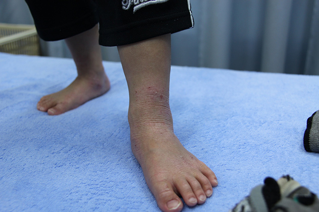 4ヶ月前までステロイドを使用していた3歳児の足