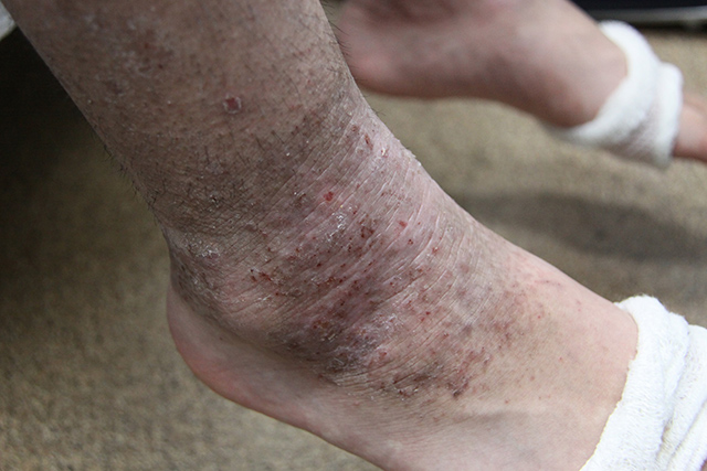2年前までステロイドを使用していた中学3年生の足