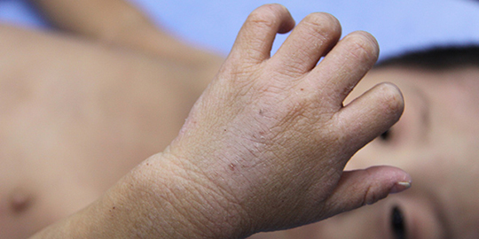 アトピー性皮膚炎