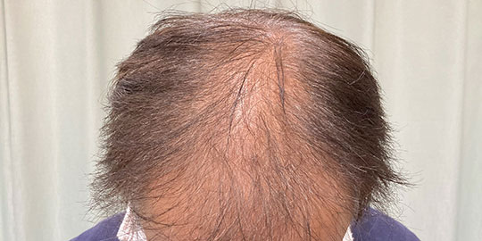 薄毛と抜け毛