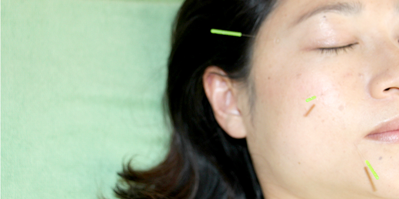 顔面神経麻痺の鍼灸治療