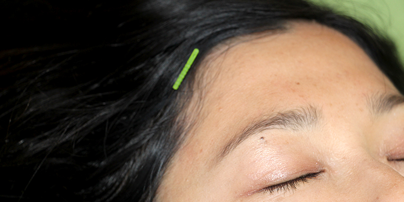 頭痛に対する鍼灸治療