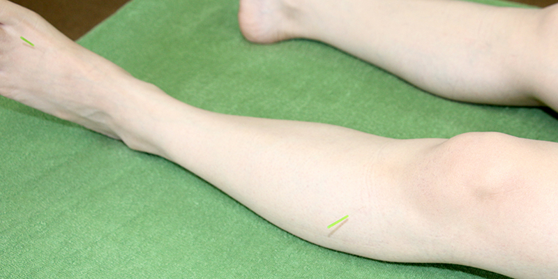 脊柱菅狭窄症の鍼灸治療