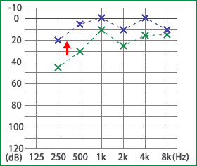 メニエール病の治療実績2