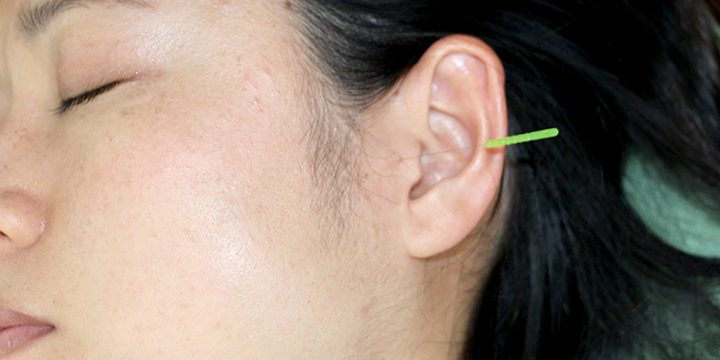 突発性難聴の治療