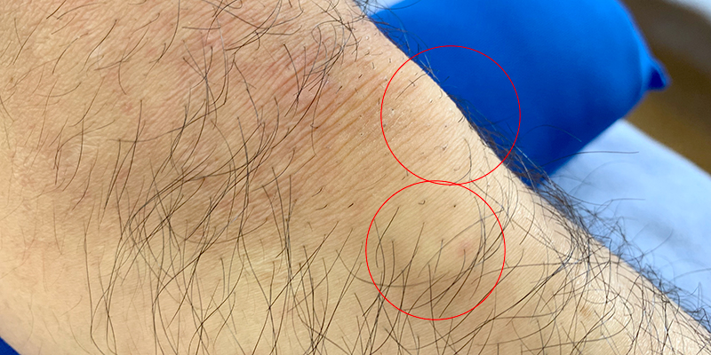 膝のオスグッド病