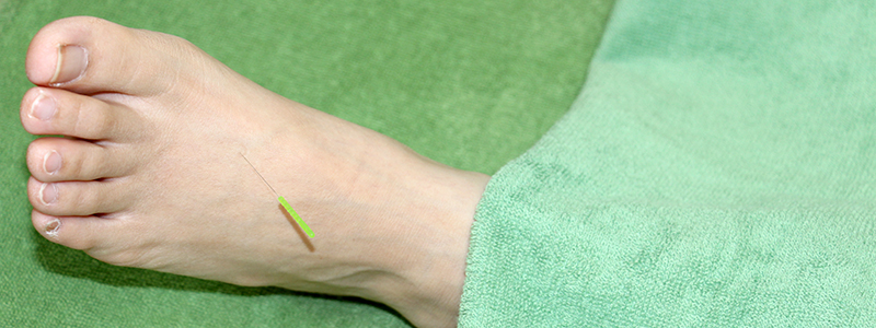 足のしびれの鍼灸治療