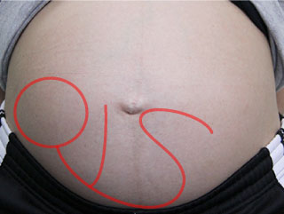 逆子体操で治らない時の逆子治療