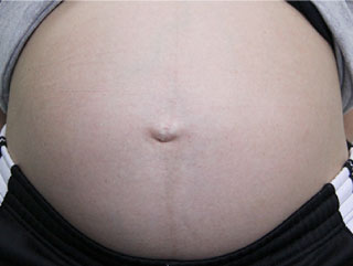 逆子体操で治らない時の逆子治療