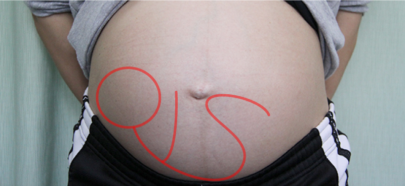 逆子体操で治らない時の逆子治療