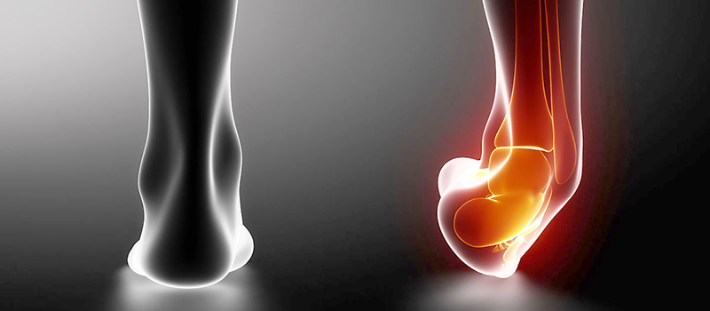 足首の捻挫の治療