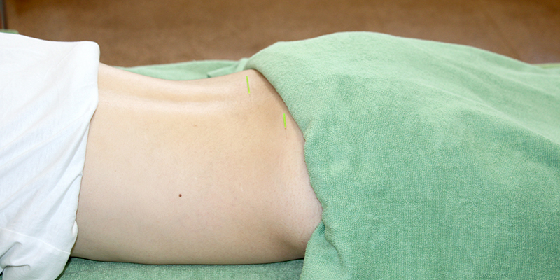 坐骨神経痛の鍼灸治療